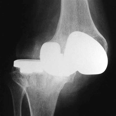 Preoperatively Severe Arthrosis And Permanent Dislocation Of The