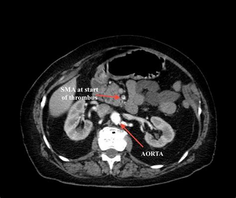 Superior Mesenteric Artery Sagittal Ct Annotated Jetem Jetem