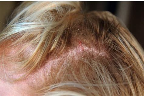 Scalp Scabs Picking