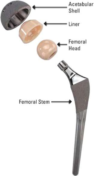 3 A typical artificial hip prosthesis. (Reproduced with permission from ...