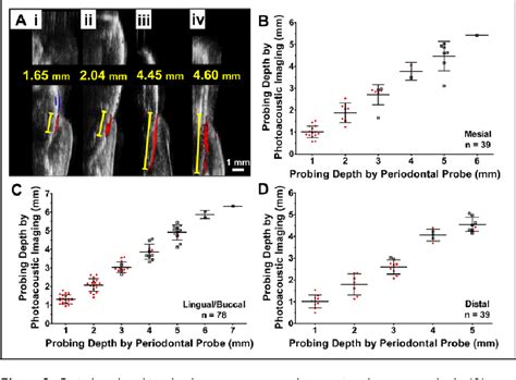 Figure 4 From Photoacoustic Imaging For Noninvasive Periodontal Probing