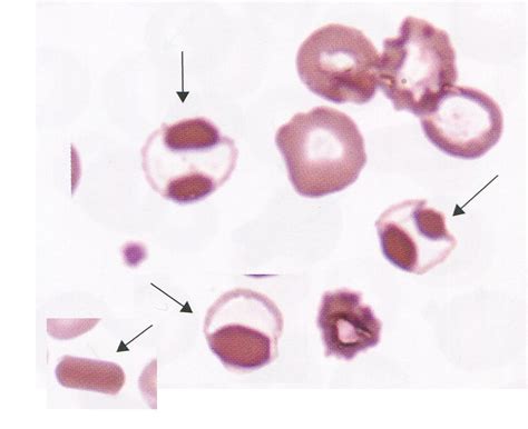 What Is Hemoglobin C Disease - Captions Trendy