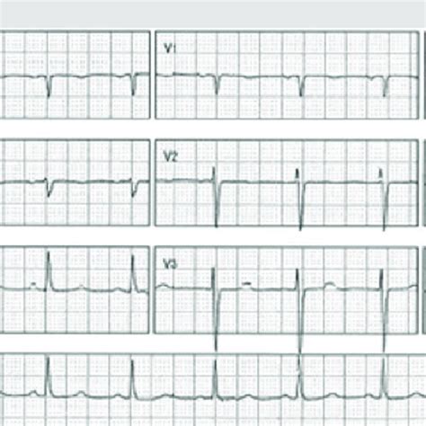 Transthoracic Echocardiogram Demonstrating Apical Ballooning Of The