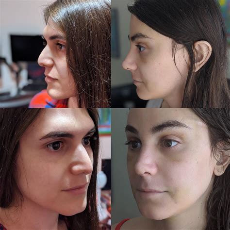 Ffs Facial Feminization Surgery 3 Weeks Post Op Facial Dysphoria