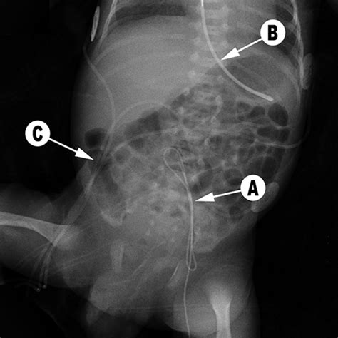 Installation Picc Line En Angiographie