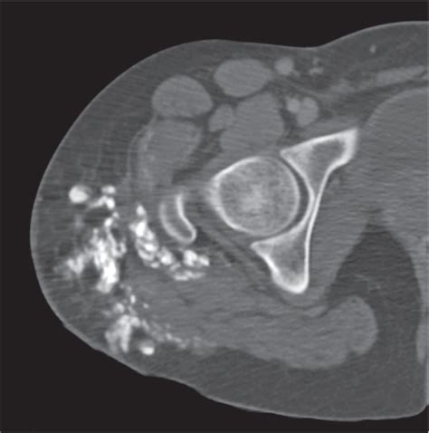 11 Soft Tissue Disease Radiology Key