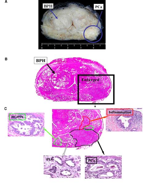 Figure From The Controversial Relationship Between Benign Prostatic