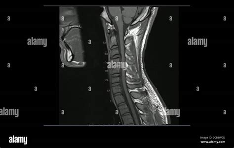 Magnetic Resonance Images Of Cervical Spine Sagittal T Weighted Image