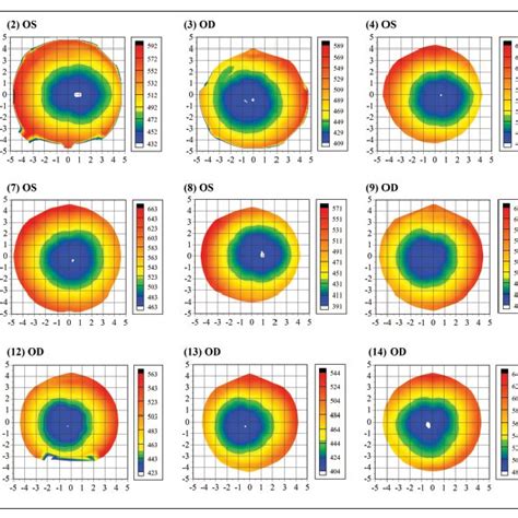 Stromal Thickness Maps Of Randomly Selected Eyes Each Plotted With