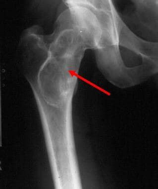 Polyostotic Fibrous Dysplasia