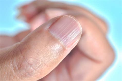 Ridges In Fingernails Causes And Treatments Riverchase Dermatology