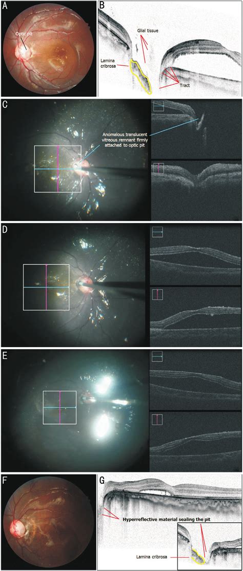 Multimodal Imaging At Various Stages Of Treatment For An Year Old