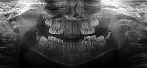 Wiedemann‐steiner Syndrome A Case Report Hirst 2021 Clinical