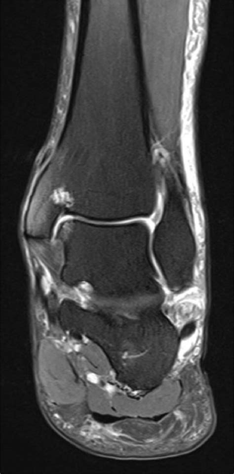 Rupture of the peroneus brevis tendon distal to the lateral malleolus,... | Download Scientific ...