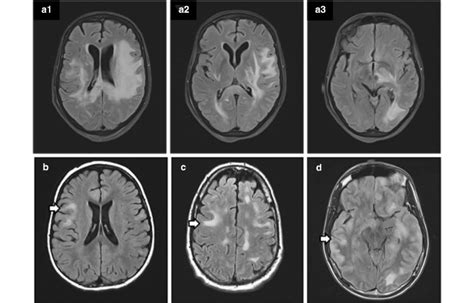 Mri Findings In Patients With Mog Associated Encephalomyelitis A A