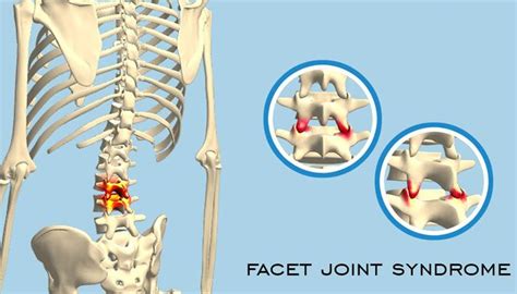 Facet Syndrome | Rajasthan Spine Surgery Center - Dr. Navin Mewara