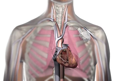 Cardiac Implantable Devices | RCEMLearning