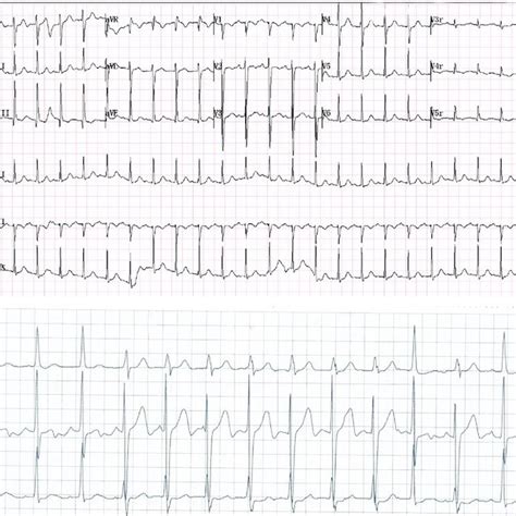 ECG Results At Postoperative Day 1 A ECG Showed Sinus Tachycardia