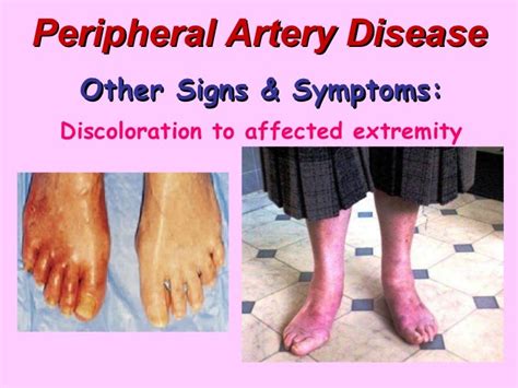 Peripheral Artery Disease - BMH/Tele