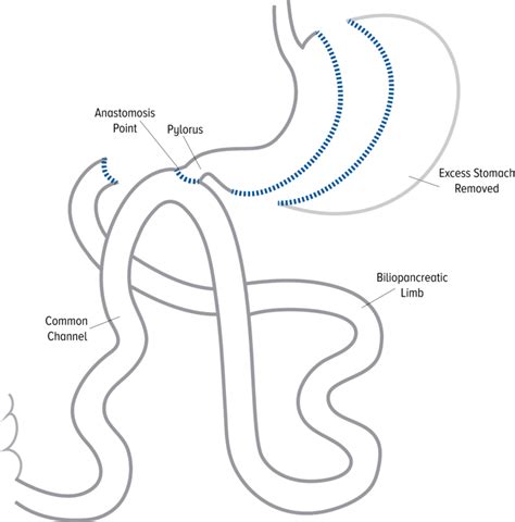 Single Anastomosis Duodenal Switch Wakemed