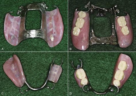 Maxillary Partial Denture Design