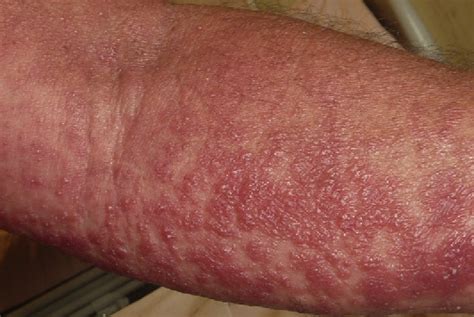 Spider Bite Allergic Reaction Rash