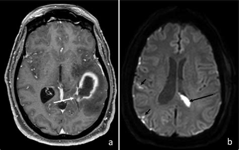 Axial MRI of the brain indicative of cerebral abscess. (a) T2-weighted... | Download Scientific ...