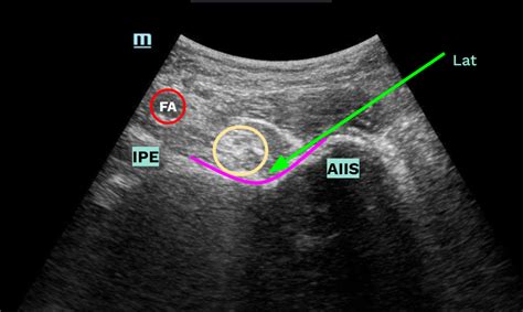 Pericapsular Nerve Group Block Sinai EM