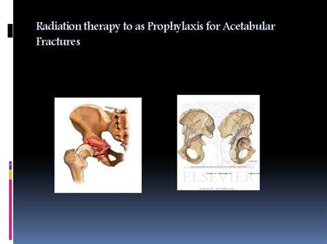 Radiation Therapy As Prophylaxis For Heterotopic Ossifications By