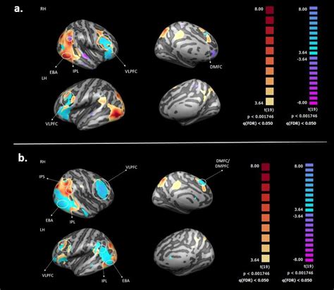 A Whole Brain Mvpa And Univariate Results Overlap Combined Map Of