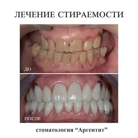 «С годами стираются зубы. Почему это происходит, чем опасно и как ...