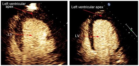 Lowdose Dobutamine Stress Myocardial Contrast Echocardiography For The