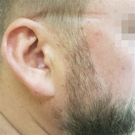 Пересадка волос: фото до и после