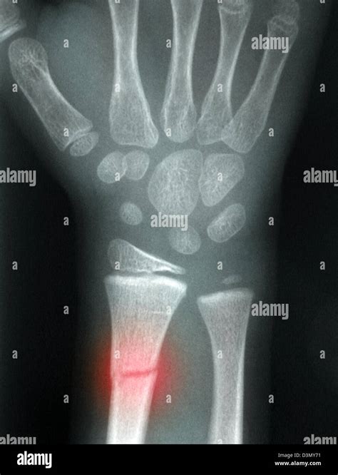 X ray mostrando una fractura de radio distal en un niño Fotografía de