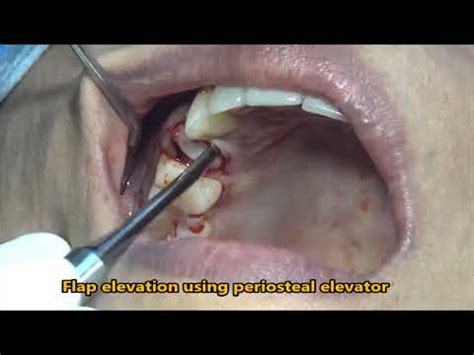 Extraction Of Root Canal Treated Premolar Youtube