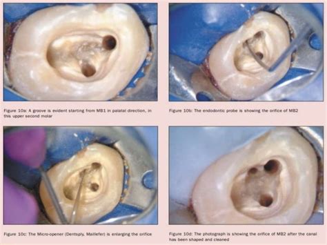 Operating Microscope In Endodontics