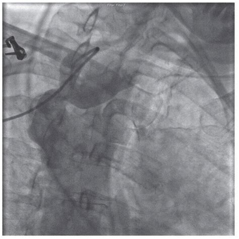 Angiography Of The Aorta And Peripheral Arteries Thoracic Key