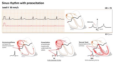 Atrio Ventricular Reentry Tachycardia Avrt Or Wpw Tachycardia