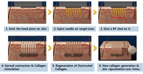 Mnrf Treatment Micro Needling Radio Frequency Venkat Center