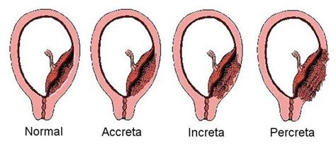 Medicina Informação Acretismo PlacentÁrio Placenta Accreta Placenta