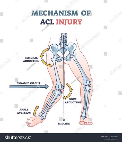 Knee Acl Mechanism