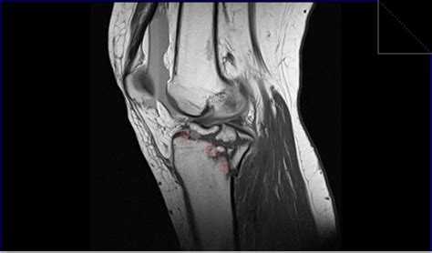 MRI Knee fractures | Radiology Article on Knee Fractures