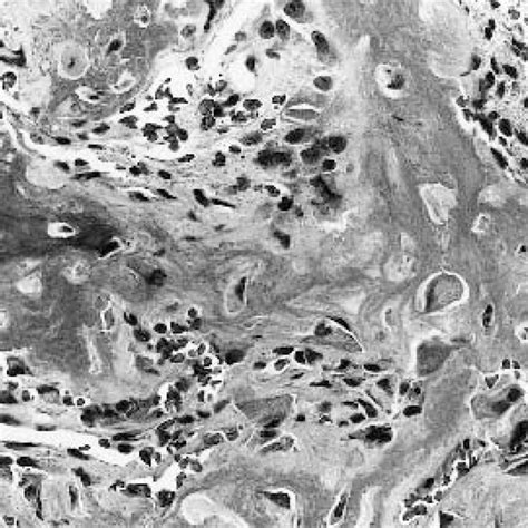 Photomicrograph showing the classical histology of osteoid osteoma ...