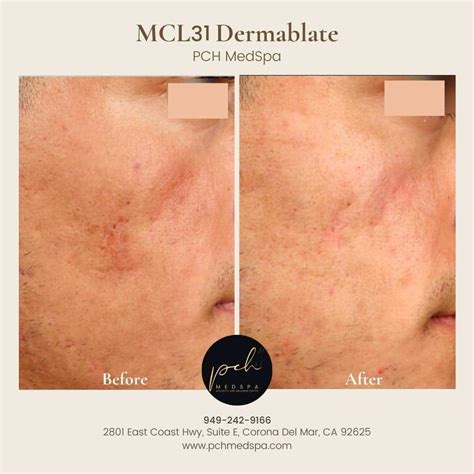 Laser Skin Resurfacing Newport Beach Orange County CA