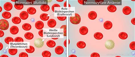 Blutwert Mcv Mittleres Erythrozyteneinzelvolumen Normalwerte