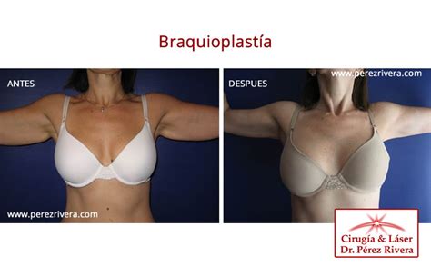 Braquioplastia Dermolipectomía de Brazos Cirugía Estética de Brazo