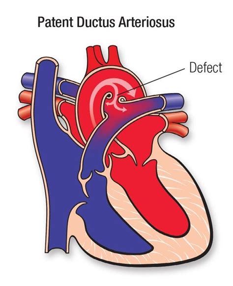 Patent Ductus Arteriosus Causes Symptômes Et Traitement