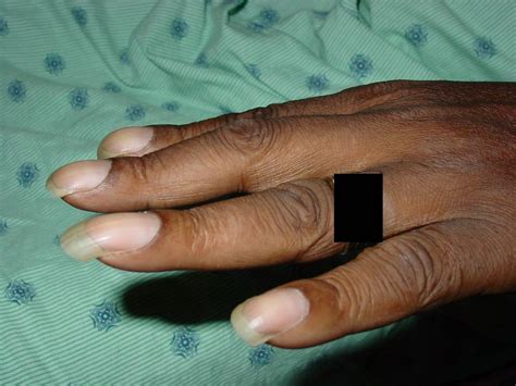 CasesBlog - Medical and Health Blog: Case of the Week: Finger Clubbing