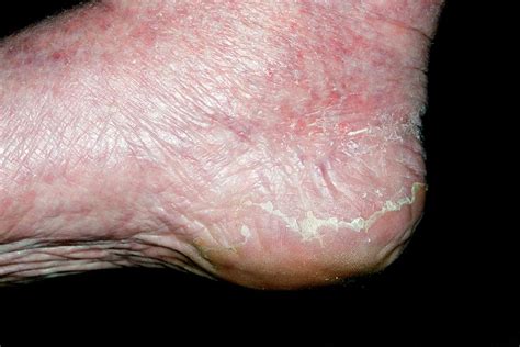 Exfoliative Dermatitis On The Foot Photograph By Dr P Marazzi Science