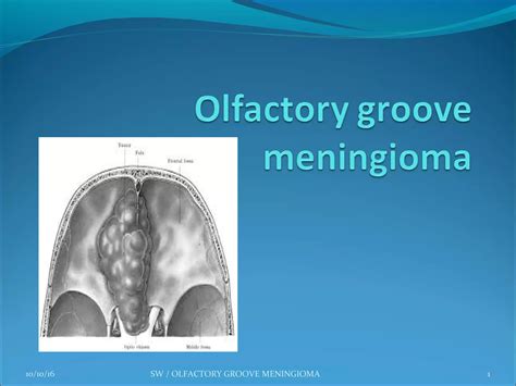 Sphenoid Wing Meningiomas Ppt